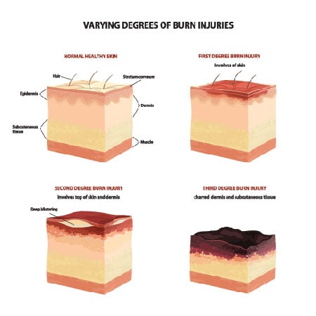 Degrees of Burn Injuries