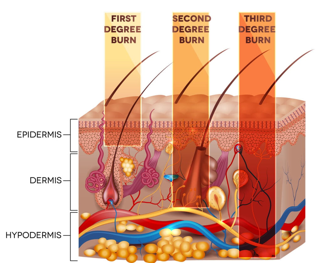 common causes of burn injuries