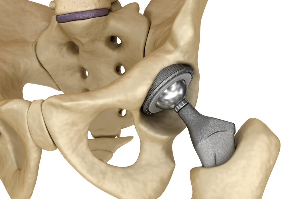 Hip Implants Complications from MetalonMetal Replacements