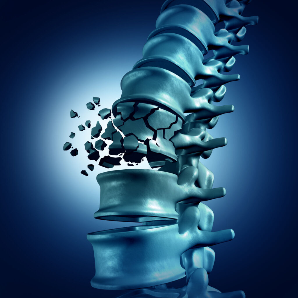 Alabama spinal cord injury lawyer