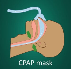 Demandas de CPAP de Philips