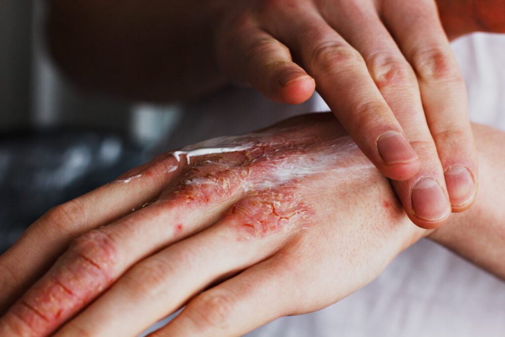 Summerlin Burn Injury Lawyers