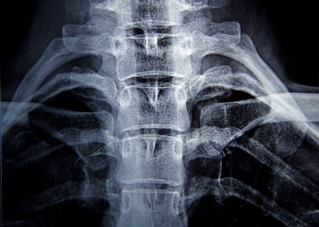 Aurora Spinal Injury Lawyer