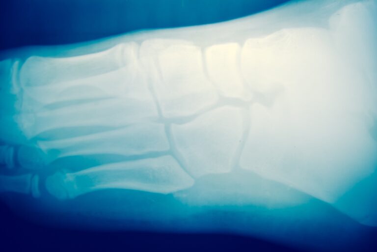 Boulder City Bone Fractures Lawyer