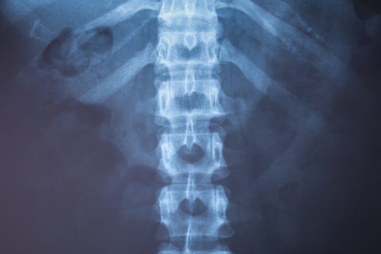 Boulder City Spinal Injury Lawyer