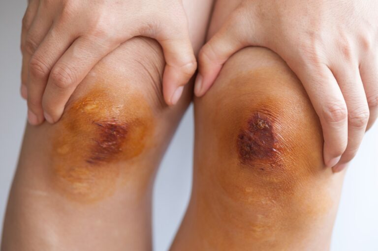 Henderson Burn Injuries Lawyer 