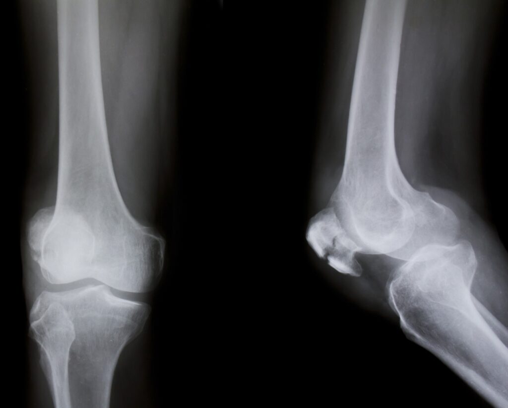 Aurora Bone Fractures Lawyer