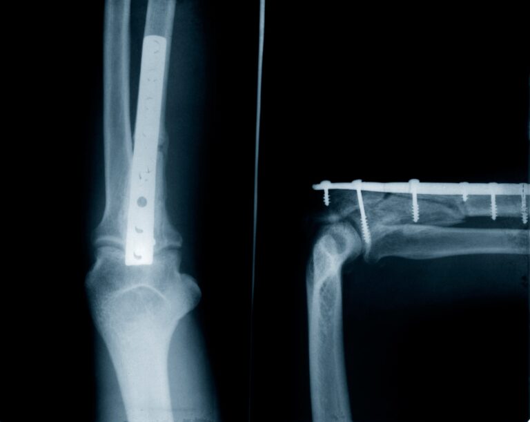 Elgin Bone Fractures Lawyer