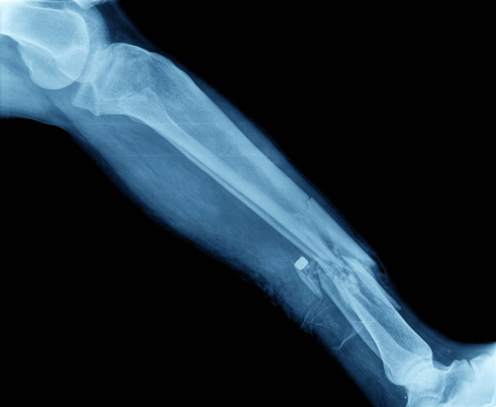 Gilbert Bone Fractures Lawyer