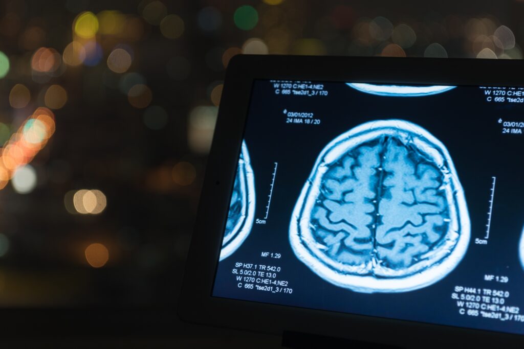 Green Valley Brain Injury Lawyer