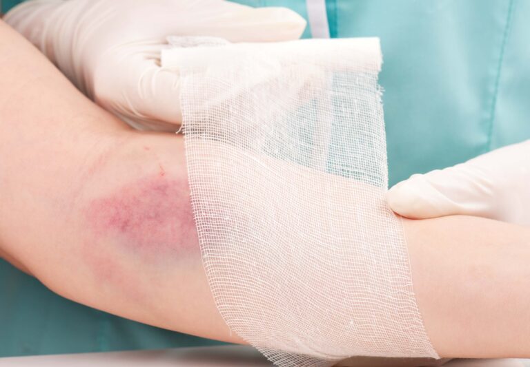 Green Valley Burn Injuries Lawyer