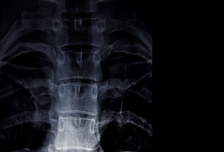 Green Valley Spinal Injury Lawyer