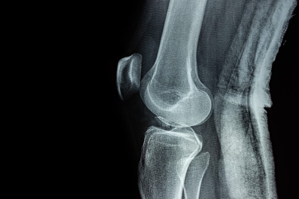 Arrowhead Ranch Bone Fractures Lawyer