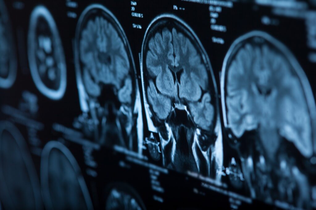 Abogados de lesiones cerebrales en Mesa