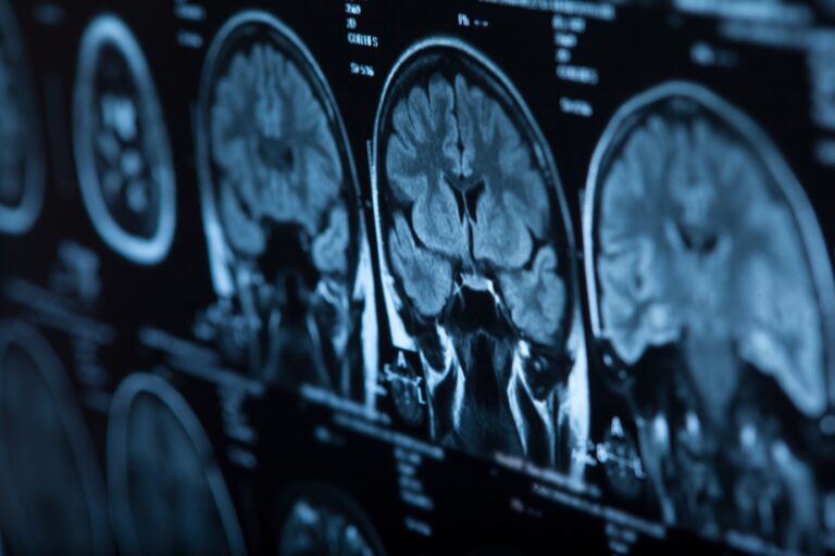 Mesa Brain Injury Lawyer