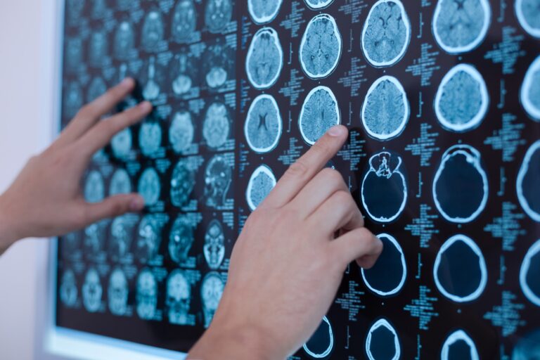 Chandler Brain Injuries Lawyer