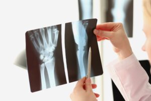 Farmington Bone Fractures Lawyer
