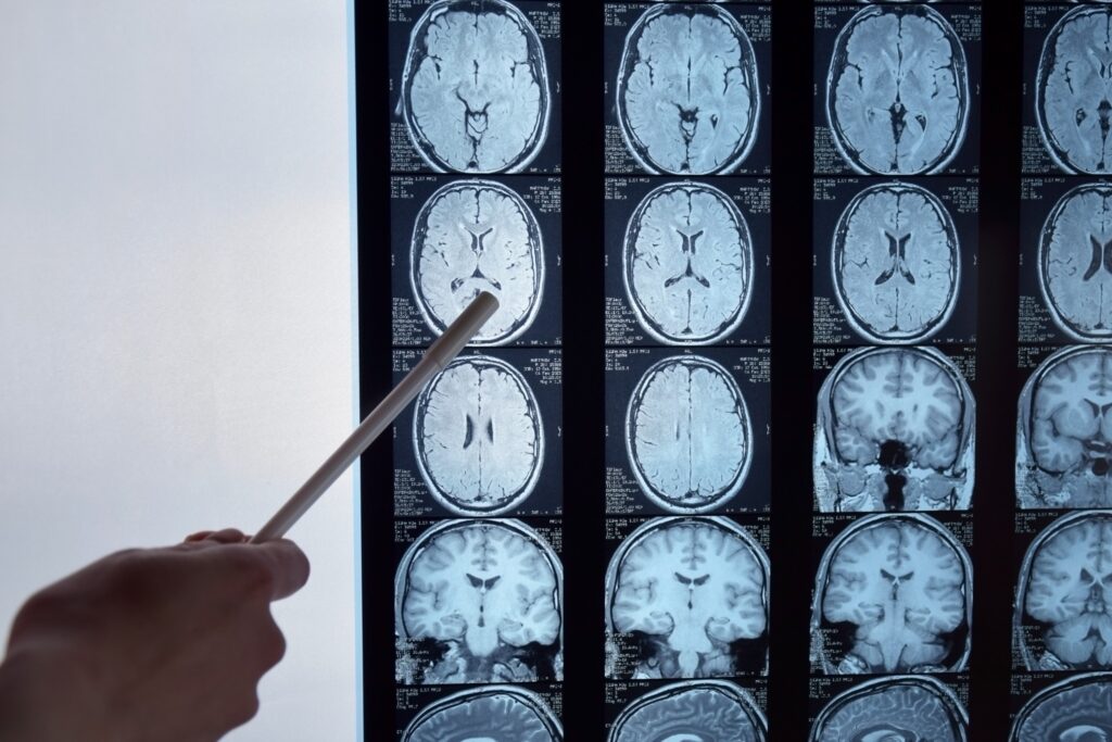 Farmington Brain Injury Lawyer