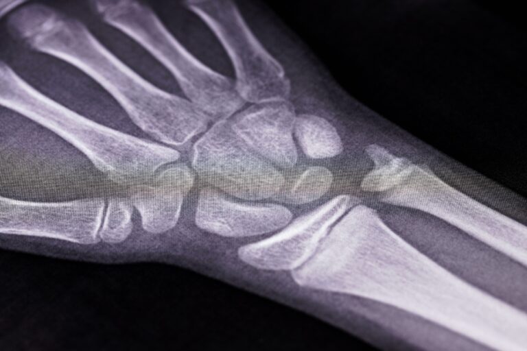 Green Valley Bone Fractures Lawyer