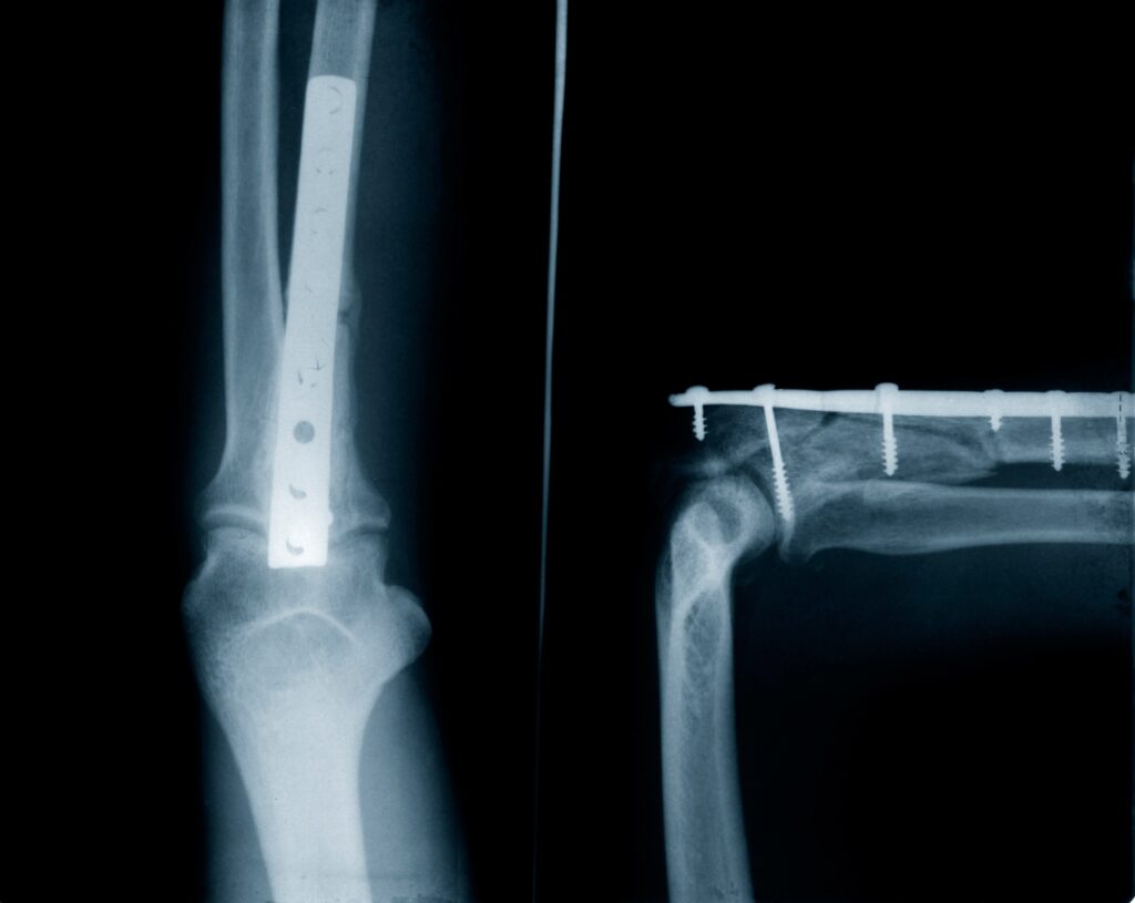 Merrillville Bone Fracture Lawyer 