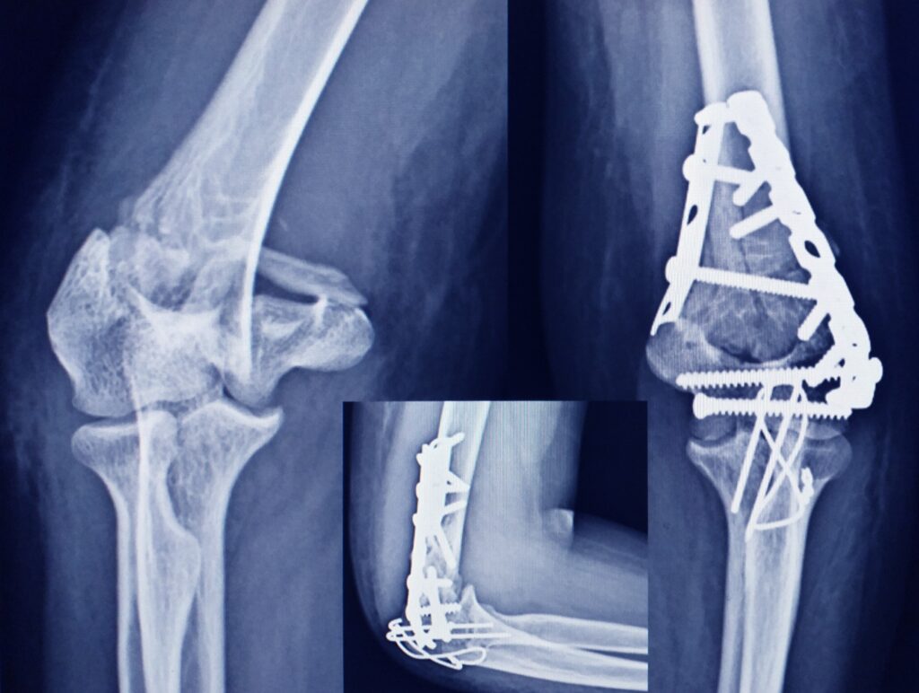 Rio Rancho Bone Fractures Lawyer