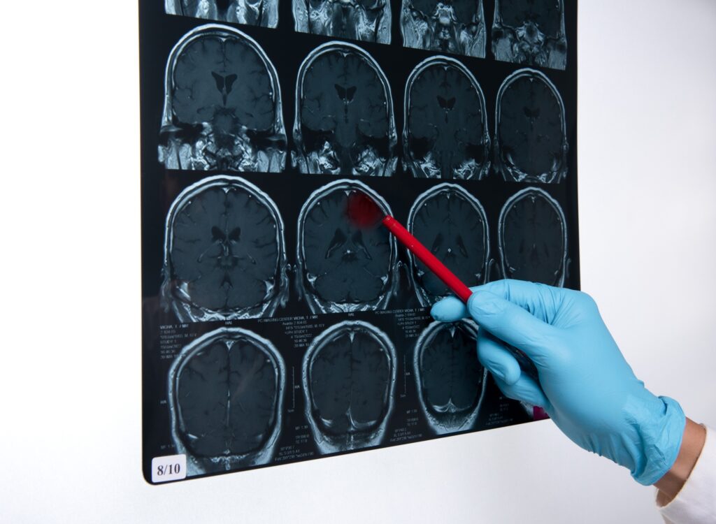 Rio Rancho Brain Injury Lawyer 