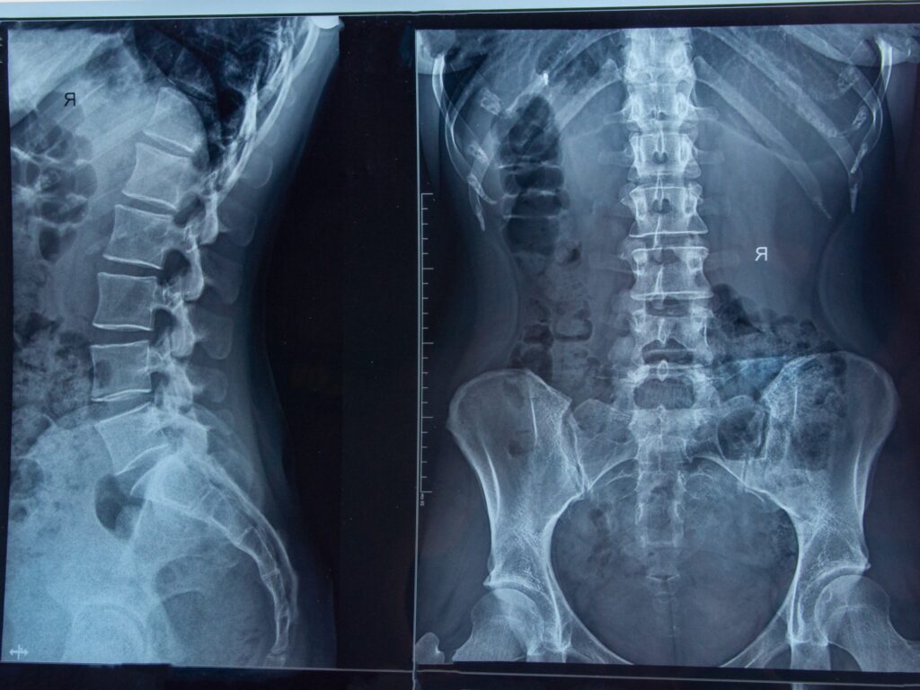 Carson City Spinal Injury Lawyer