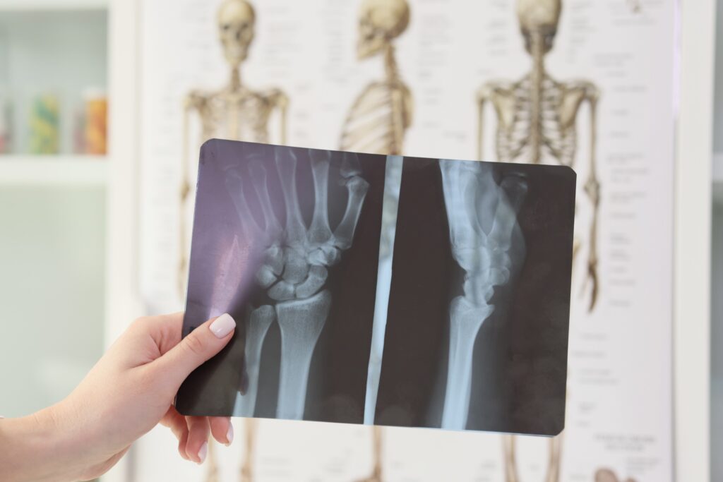 Las Vegas Bone Fractures Lawyers 