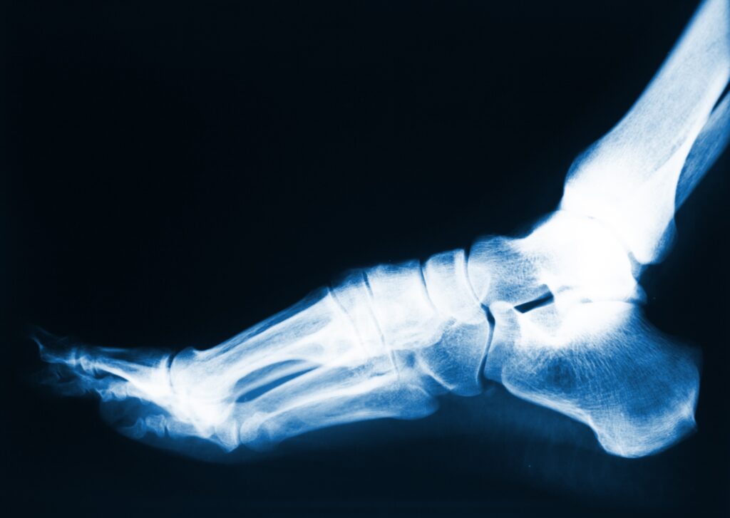Sparks Bone Fractures Lawyer