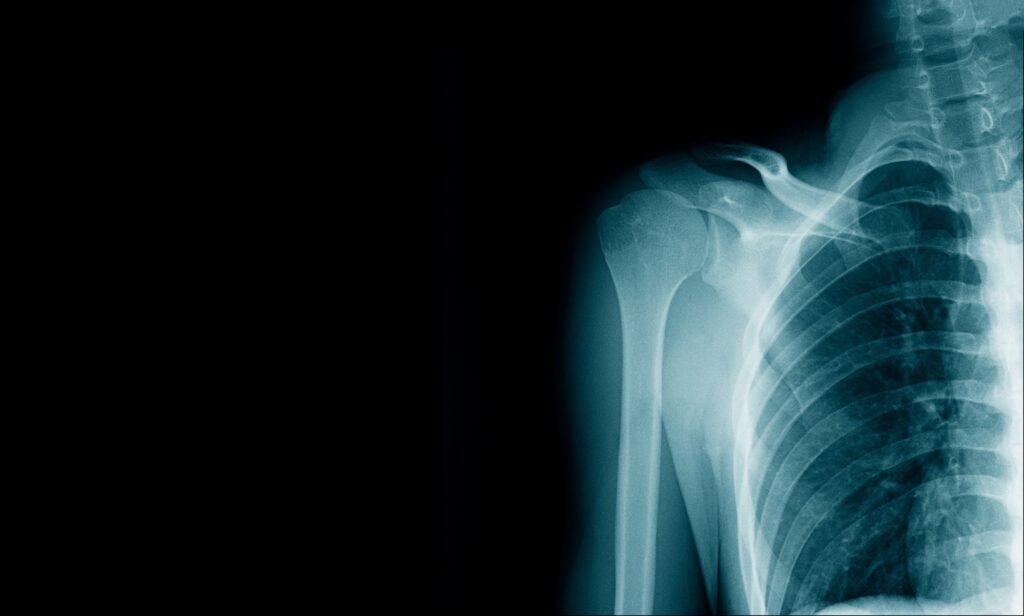 Cold Springs Bone Fractures Lawyer