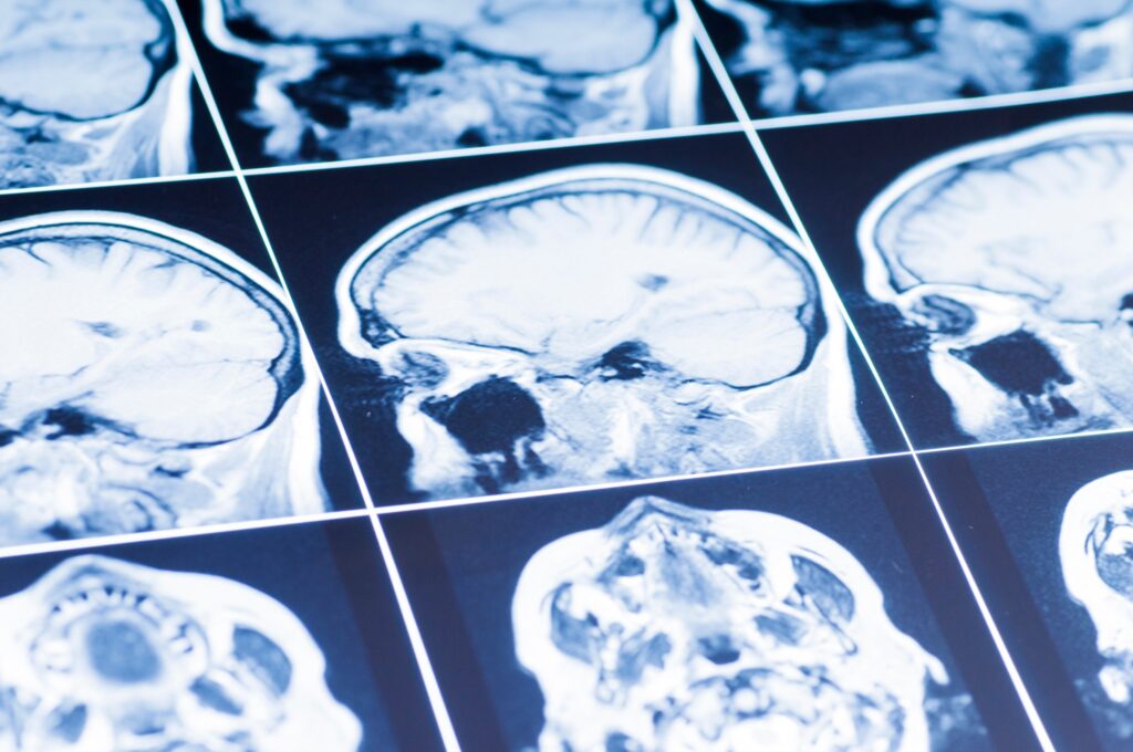 Cold Springs Brain Injury Lawyer