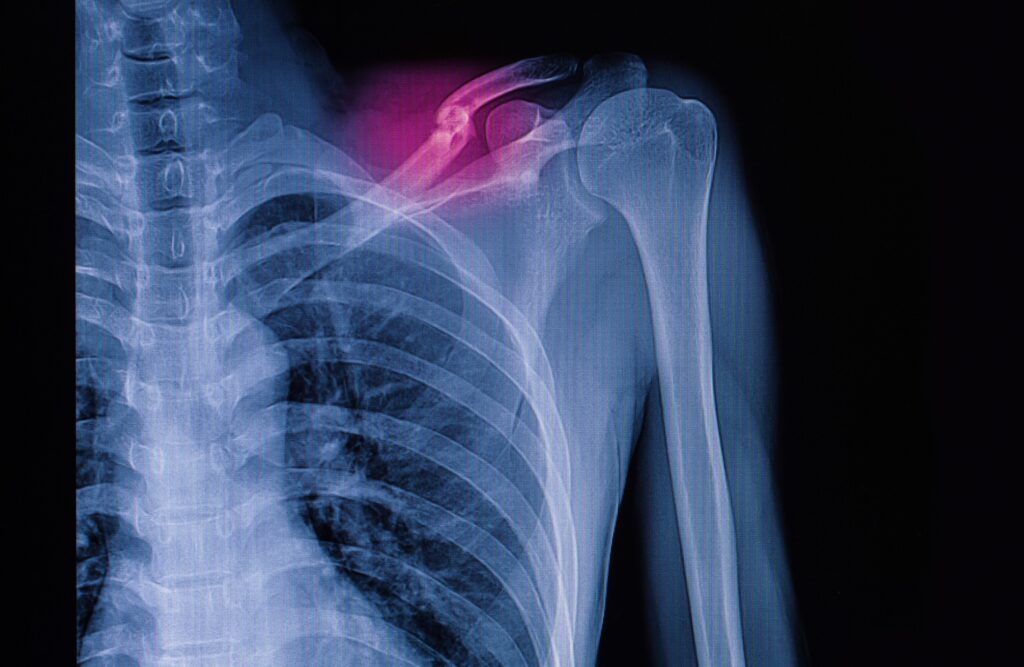 Winnemucca Bone Fractures Lawyer