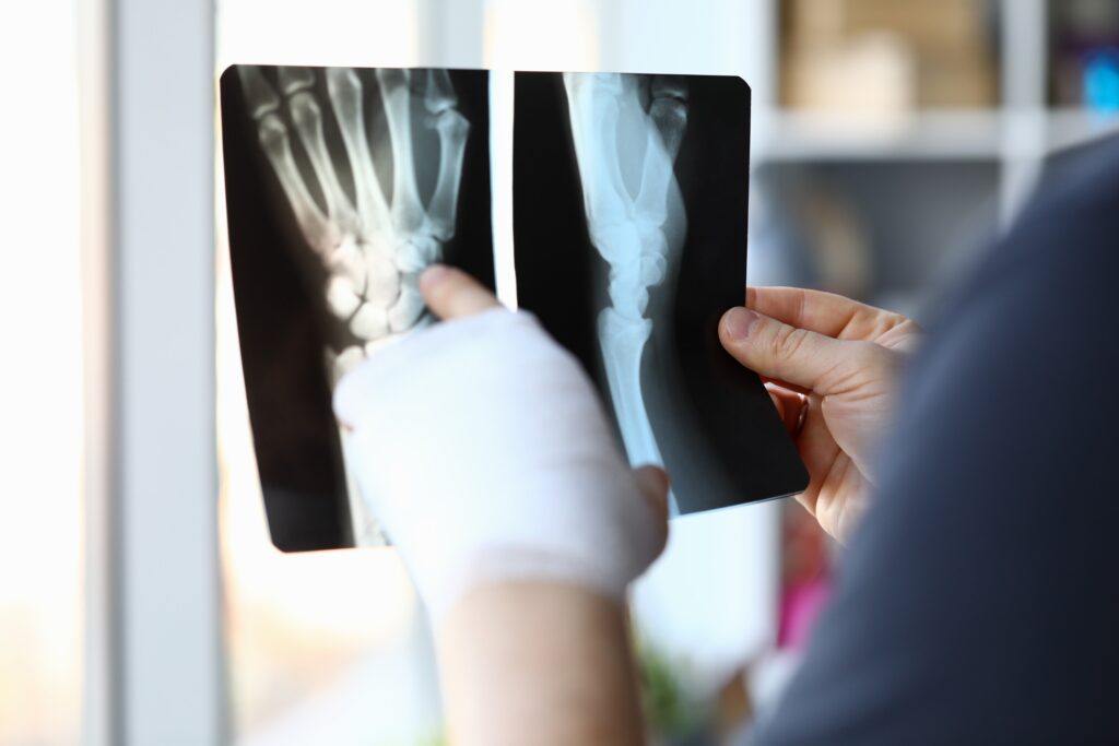 Washoe Valley Bone Fractures Lawyer