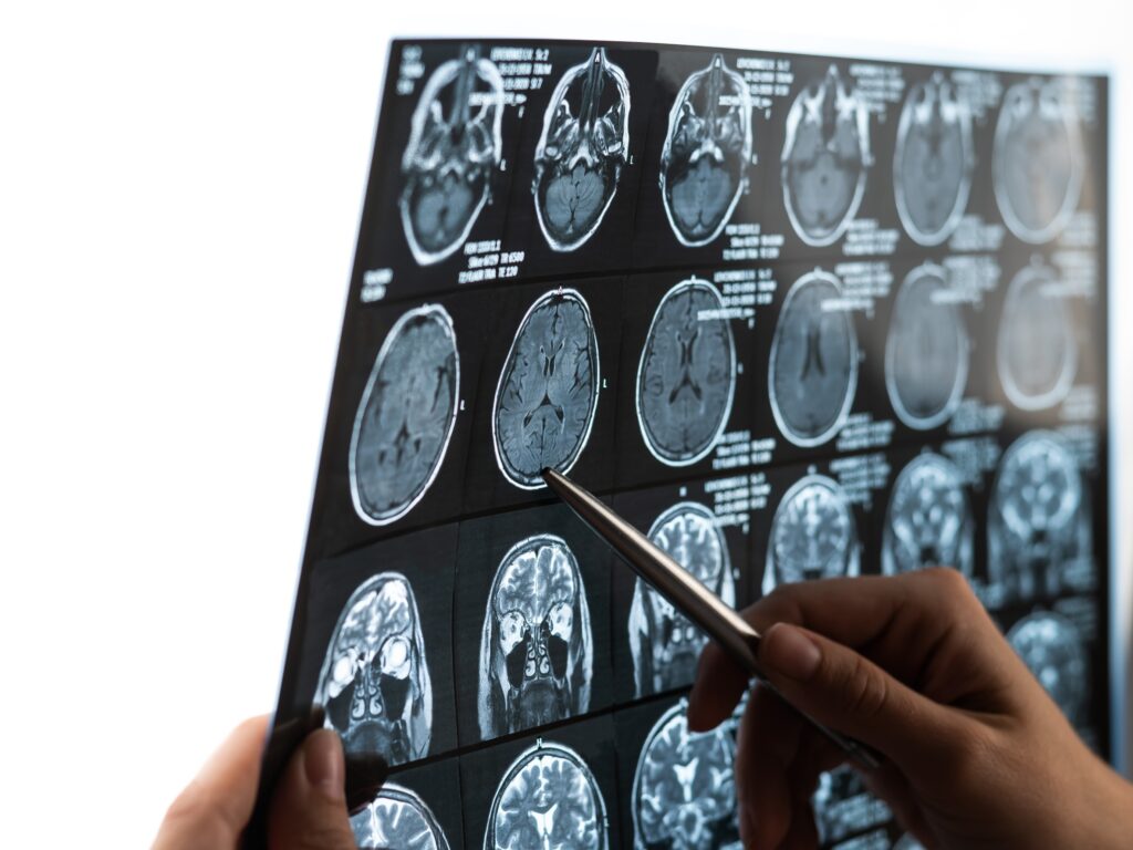 Washoe Valley Brain Injury Lawyer