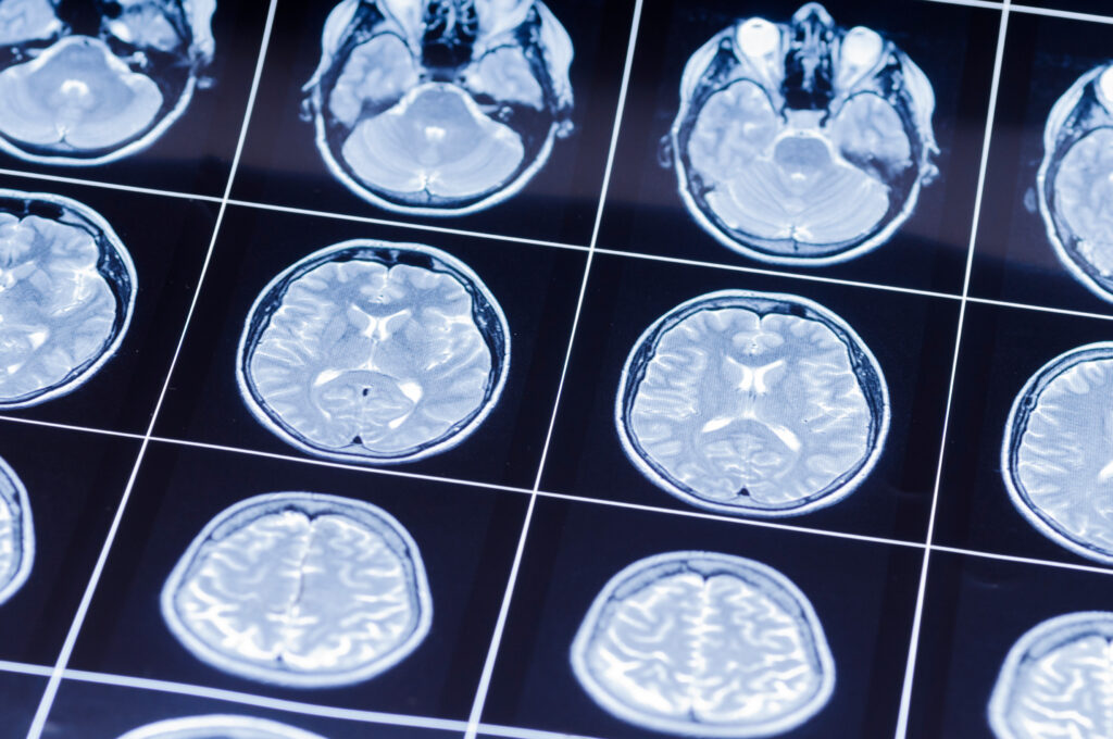 Laughlin Brain Injury Lawyer