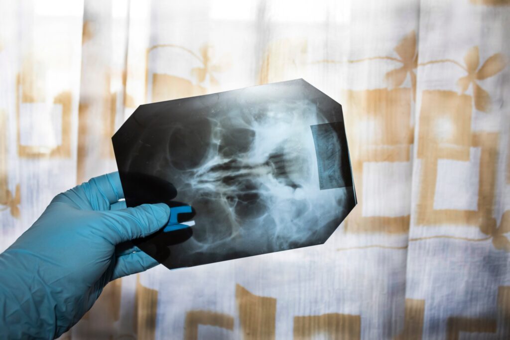 Santa Rosa Bone Fractures Lawyer