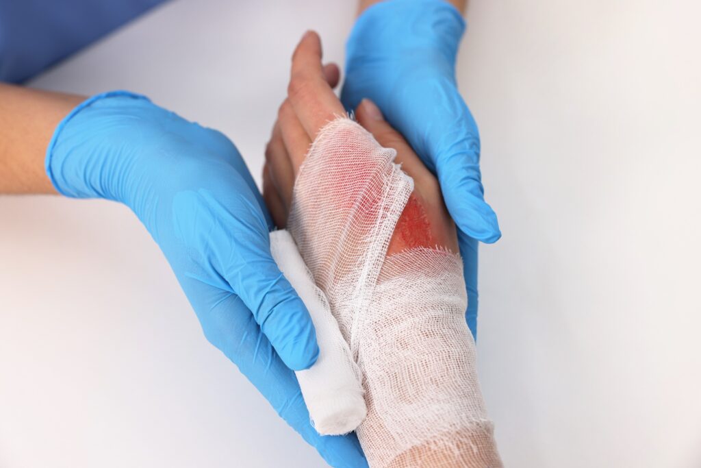 Sun Valley Burn Injuries Lawyer