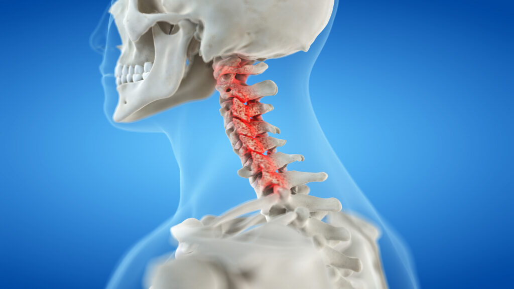 Abogados de lesiones por latigazo cervical en Elgin