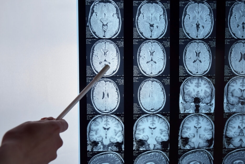 Hawthorne Brain Injury Lawyer