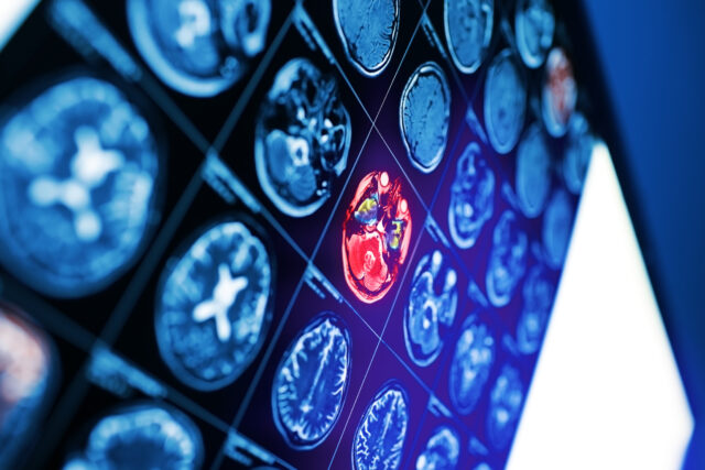 Waukegan Brain Injury Lawyer