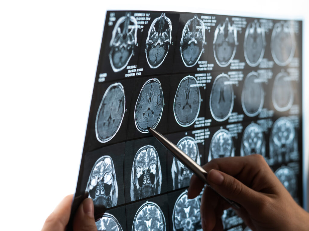 Des Plaines Brain Injury Lawyer