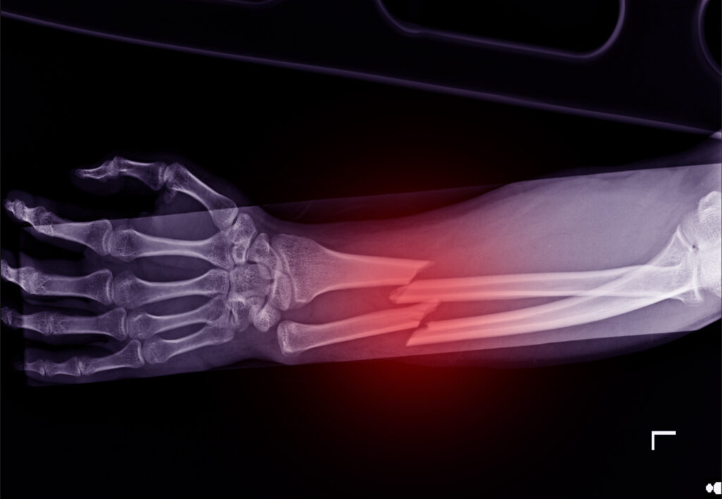 Tacoma Bone Fractures Lawyer