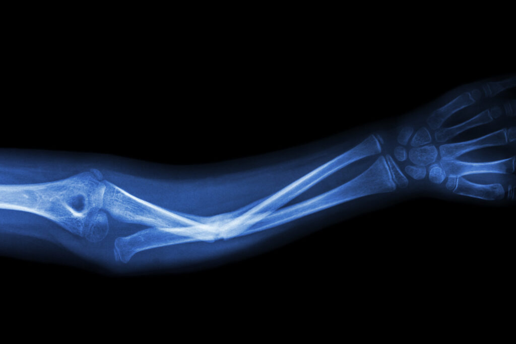 Laguna Niguel Bone Fractures Lawyer