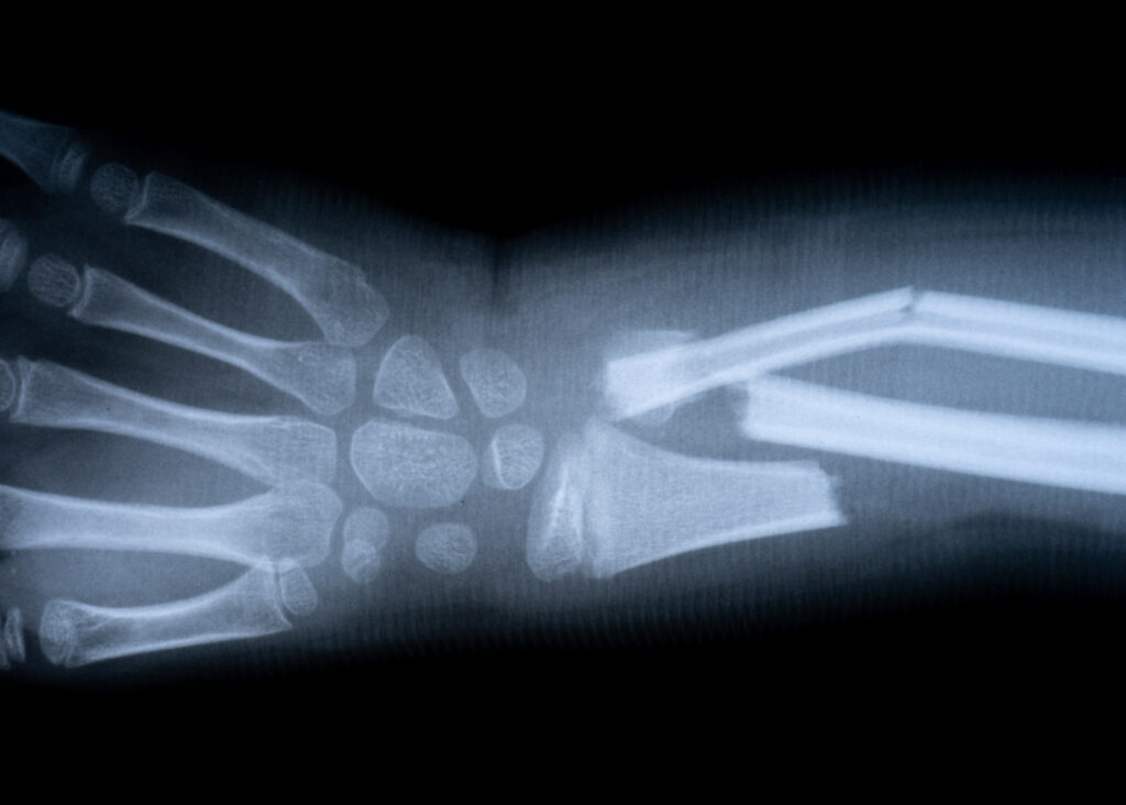 Santa Ana Bone Fractures Lawyer