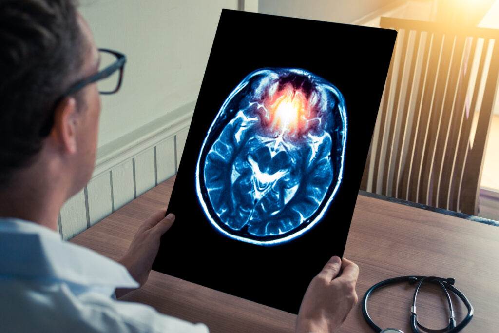 Fullerton Brain Injury Lawyer