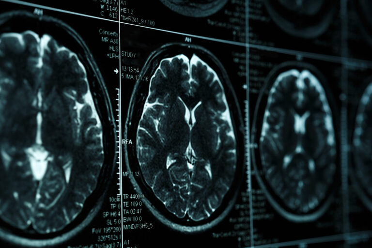 Garden Grove Brain Injury Lawyer