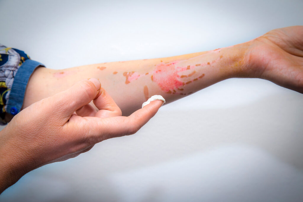 Irvine Burn Injuries Lawyer