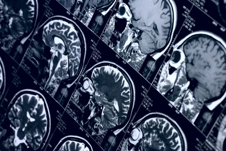 Bellevue Brain Injury Lawyer