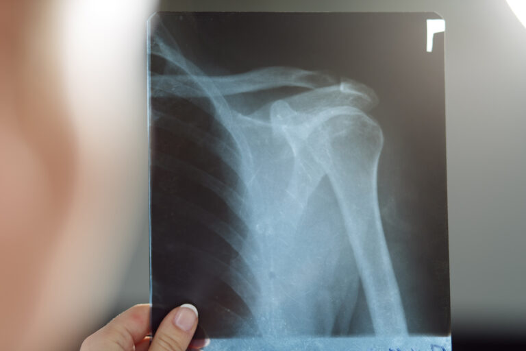 Glendale, Arizona Bone Fractures Lawyer