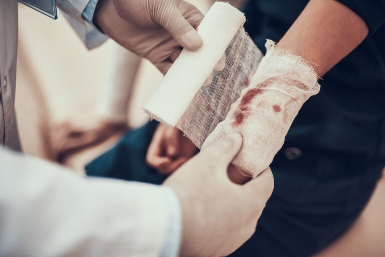 Newport Beach Burn Injuries Lawyer